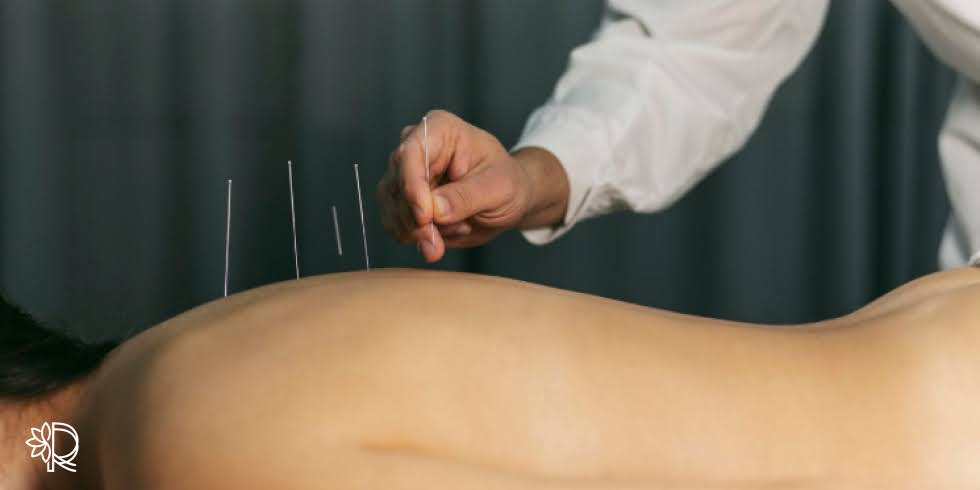 Benefícios da Acupuntura para Dores Físicas e Emocionais