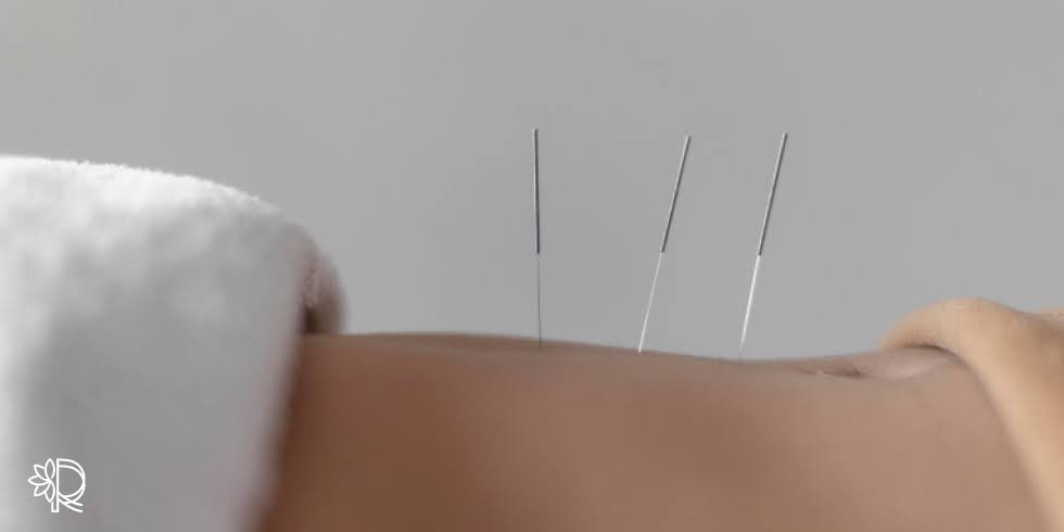 Benefícios da Acupuntura para Dores Físicas e Emocionais